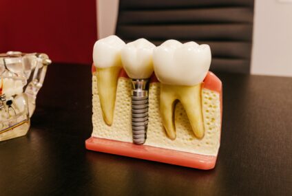 Tipuri de implanturi dentare populare in randul pacientilor