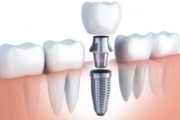 Implant dentar clasic si implant dentar cu incarcare imediata